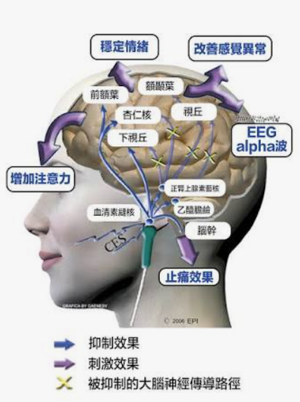 CES 經顱微電流刺激治療